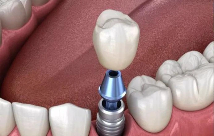 Innovative Solutions For The Equipment And Device Medical Fastener Industry